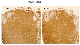 LYMPH NODE
Effaced with Monotonous lymphoid aggregates Intermediate sized atypical cells
CD3+ TCL1A+
 