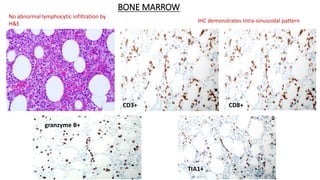 BONE MARROW
CD3+ CD8+
granzyme B+
TIA1+
No abnormal lymphocytic infiltration by
H&E
IHC demonstrates Intra-sinusoidal pattern
 