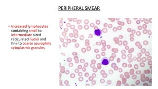 PERIPHERAL SMEAR
• Increased lymphocytes
containing small to
intermediate sized
reticulated nuclei and
fine to coarse azurophilic
cytoplasmic granules
 