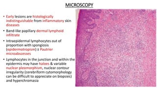 MICROSCOPY
• Early lesions are histologically
indistinguishable from inflammatory skin
diseases
• Band-like papillary dermal lymphoid
infiltrate
• Intraepidermal lymphocytes out of
proportion with spongiosis
(epidermotropism) ± Pautrier
microabscesses
• Lymphocytes in the junction and within the
epidermis may have haloes & variable
nuclear pleomorphism, nuclear contour
irregularity (cerebriform cytomorphology
can be difficult to appreciate on biopsies)
and hyperchromasia
 