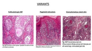VARIANTS
Folliculotropic MF Granulomatous slack skin
Pagetoid reticulosis
 