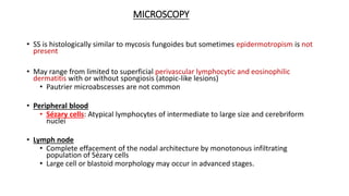 MICROSCOPY
• SS is histologically similar to mycosis fungoides but sometimes epidermotropism is not
present
• May range from limited to superficial perivascular lymphocytic and eosinophilic
dermatitis with or without spongiosis (atopic-like lesions)
• Pautrier microabscesses are not common
• Peripheral blood
• Sézary cells: Atypical lymphocytes of intermediate to large size and cerebriform
nuclei
• Lymph node
• Complete effacement of the nodal architecture by monotonous infiltrating
population of Sézary cells
• Large cell or blastoid morphology may occur in advanced stages.
 