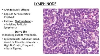 NODAL T- CELL LYMPHOMAS
 