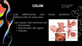TU LOGO
AQUÍ
Las adherencias casi nunca producen
obstrucción en esta zona.
Las causas más comunes son:
• Carcinoma.
• Diverticulitis del sigma.
• Vólvulo.
 