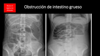 Obstrucción de intestino grueso
Busca el
sigma no
dilatado
 