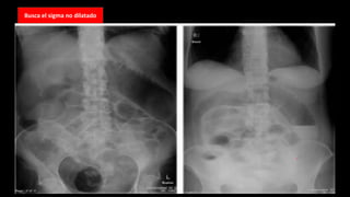 Busca el sigma no dilatado
 