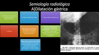 Semiología radiológica
A)Dilatación gástrica
1. Obstrucción pilórica (casi
siempre por úlcera
piloroduodenal).
2. Dilatación gástrica refleja. 3. Atonía gástrica (diabéticos).
4. Uremia
Obstrucciones GI Adulto:
Secundaria a estenosis
cicatricial: post-úlcera o
carcinoma pilórico
Casos de vólvulo gástrico
asociados a herniación
diafragmática: Cuadro agudo,
violento, clínicamente
caracterizado por el deseo de
vomitar del paciente, sin
conseguirlo.
Obstrucción duodenal del adulto:
Frecuentemente a cicatriz de
úlcera, síndrome de la arteria
mesentérica superior y
obstrucción intraluminal por
cálculo biliar o cuerpo extraño.
 
