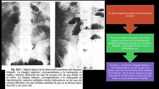 El colon y el intestino delgado distales a
una obstrucción se vacían de gas y de
heces, entre las 24 y 48 horas del comienzo
de la misma , por lo que la ausencia de gas
más allá de la obstrucción, indica que ésta
tiene ya cierto tiempo de evolución
Cuando se repite el estudio, unas horas
después, se puede ver la acumulación
progresiva de gas y líquido en el intestino
delgado , con producción de niveles
hidroaéreos, etc.
En fases tempranas puede existir un patrón
anodino
 