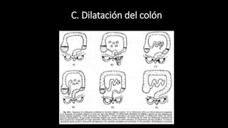 C. Dilatación del colón
 