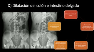 D) Dilatación del colón e intestino delgado
Dilatación aislada de
colón
Obstrucción
simultanea del
delgado y del grueso
Obstrucción cólica
con válvula ileocecal
incompleta
Oclusión cólica con
válvula continente y
obstrucción
secundaria de
intestino delgado
Oclusión intestinal
con íleo paralitico
asociado
 