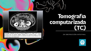 E N O B S T R U C C I Ó N I N T E S T I N A L
 