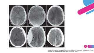 31
Rajajee, Venkatakrishna, Maria E. Moreira, and Alejandro A. Rabinstein. "Management of acute
moderate and severe traumatic brain injury." Up to Date (2021).
 