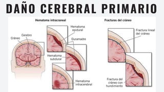 DAÑO CEREBRAL PRIMARIO
 