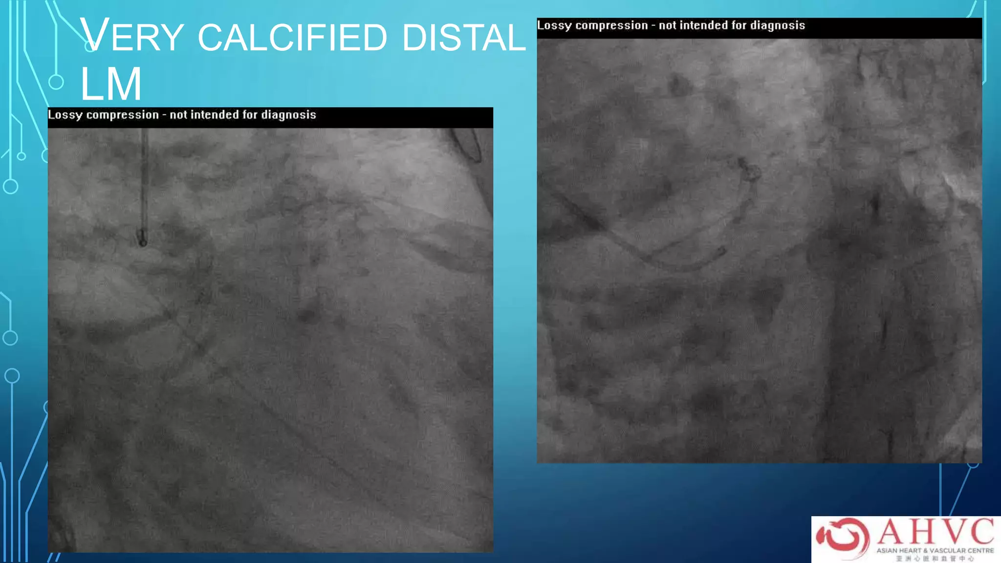 VERY CALCIFIED DISTAL
LM
 