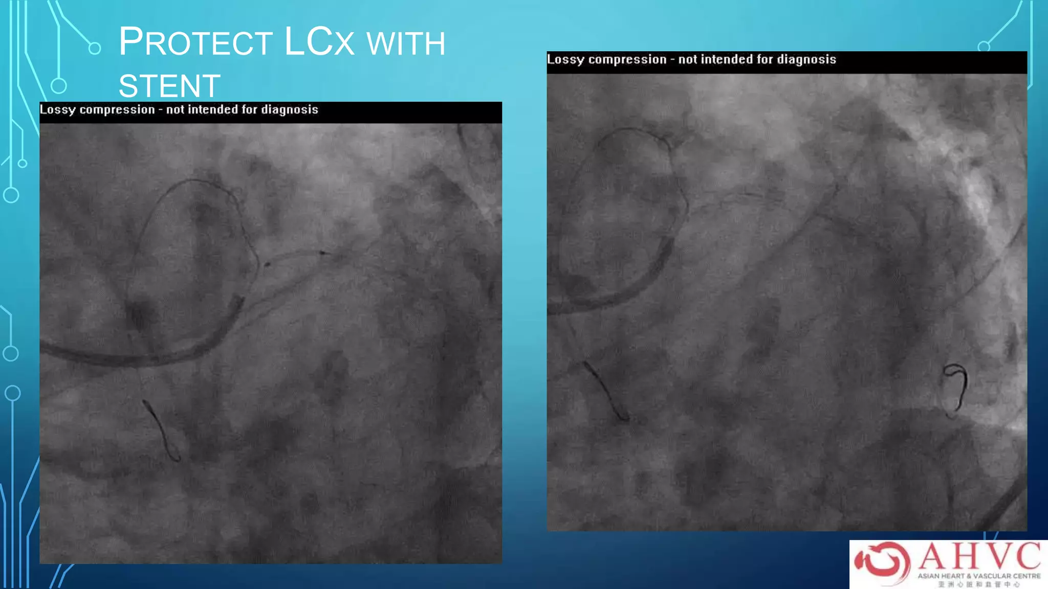 PROTECT LCX WITH
STENT
 
