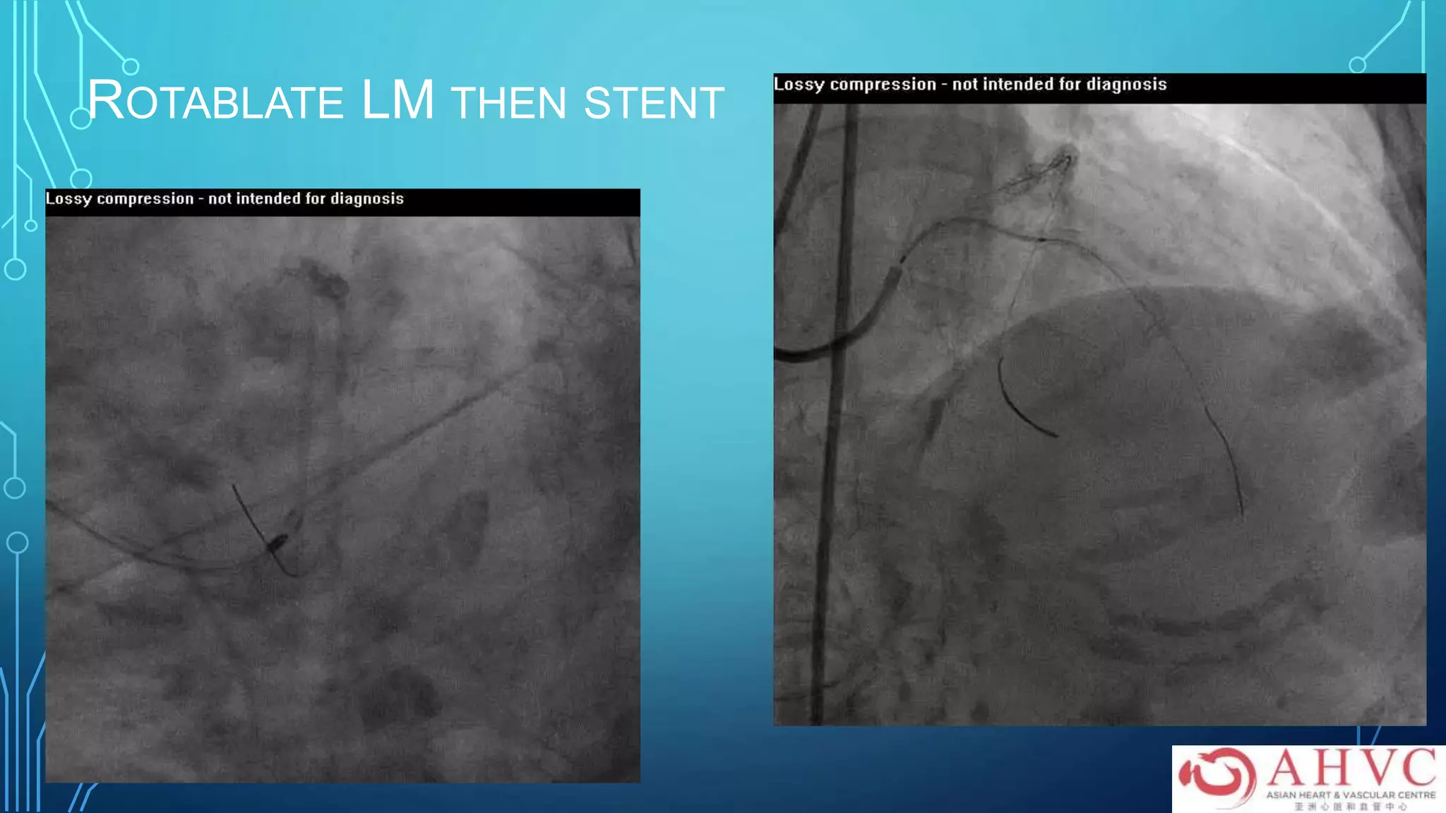 ROTABLATE LM THEN STENT
 