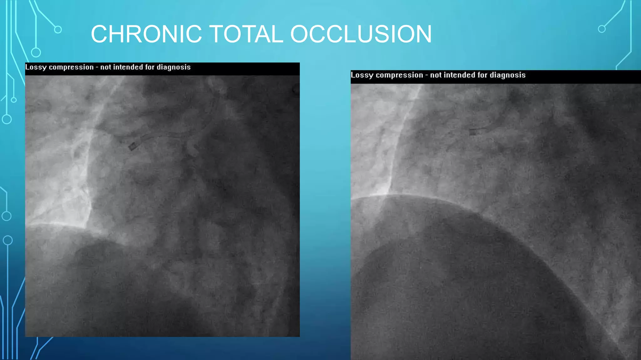 CHRONIC TOTAL OCCLUSION
 