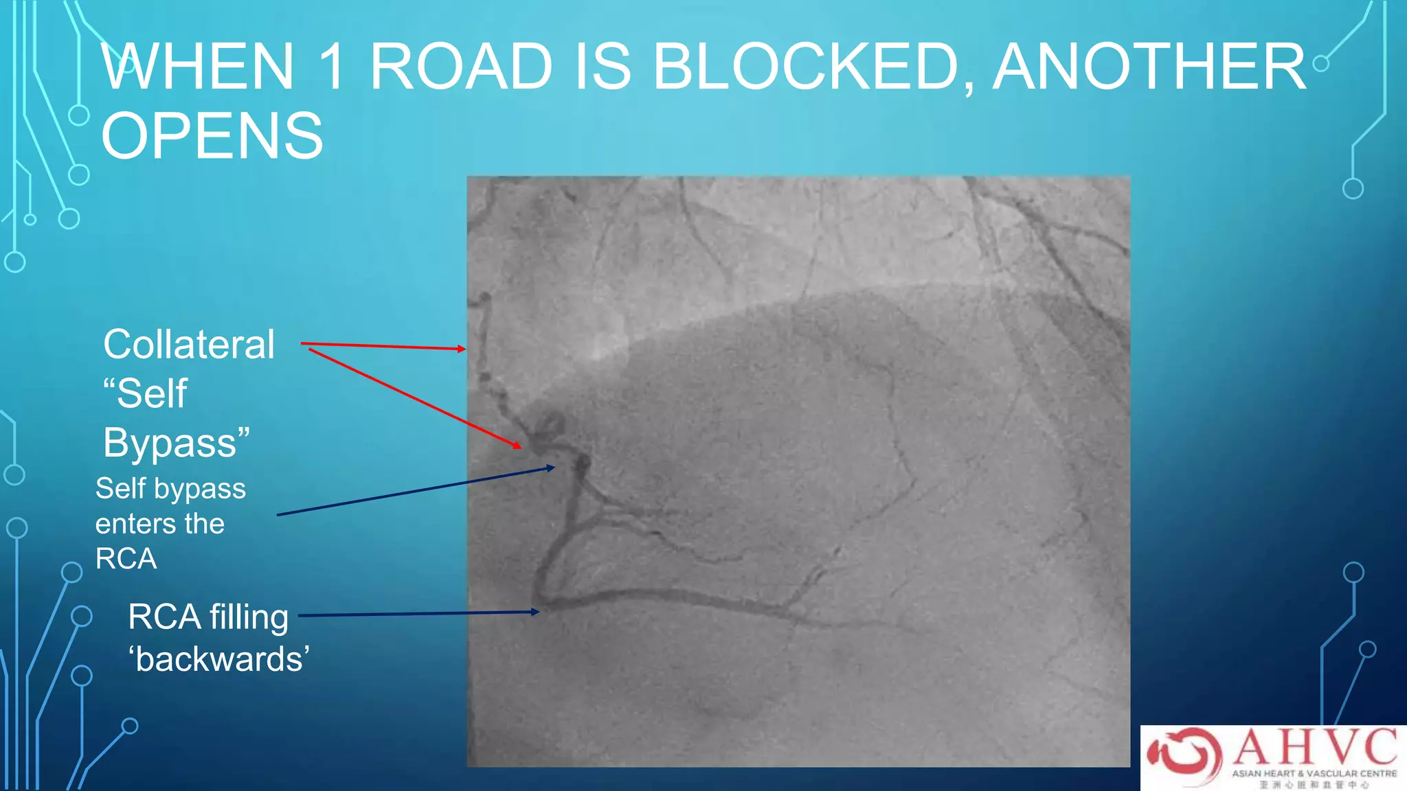 WHEN 1 ROAD IS BLOCKED, ANOTHER
OPENS
Collateral
“Self
Bypass”
Self bypass
enters the
RCA
RCA filling
‘backwards’
 