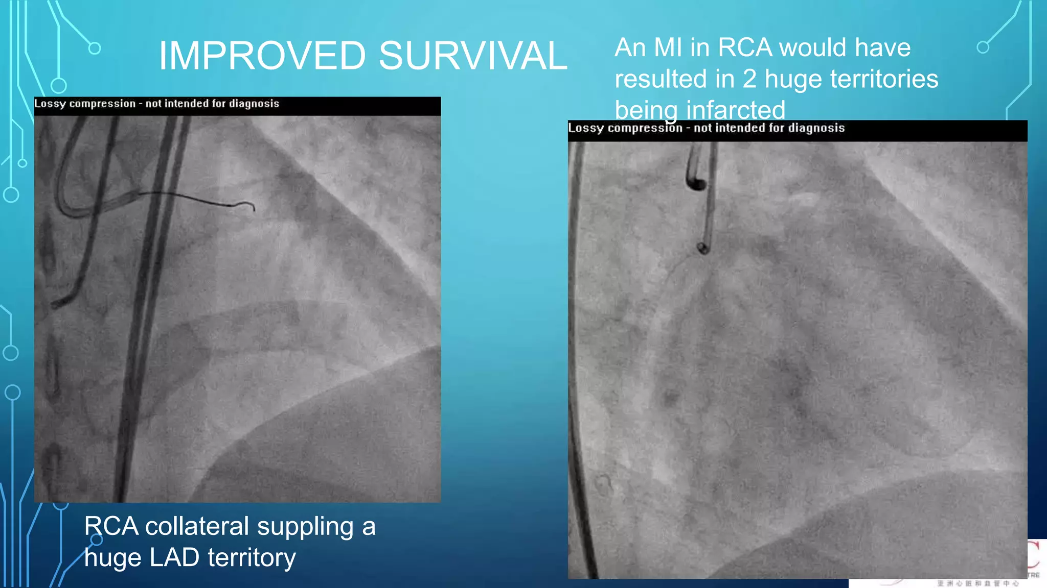 IMPROVED SURVIVAL An MI in RCA would have
resulted in 2 huge territories
being infarcted
RCA collateral suppling a
huge LAD territory
 