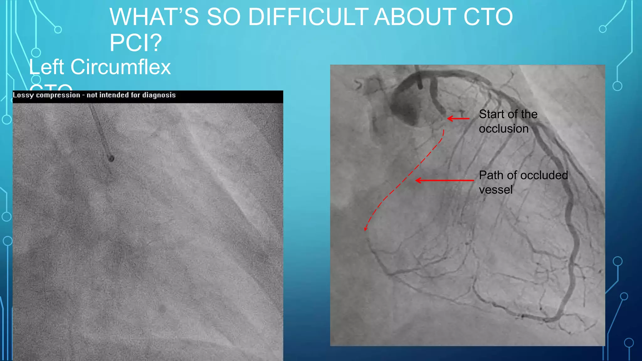 WHAT’S SO DIFFICULT ABOUT CTO
PCI?
Left Circumflex
CTO
Start of the
occlusion
Path of occluded
vessel
 