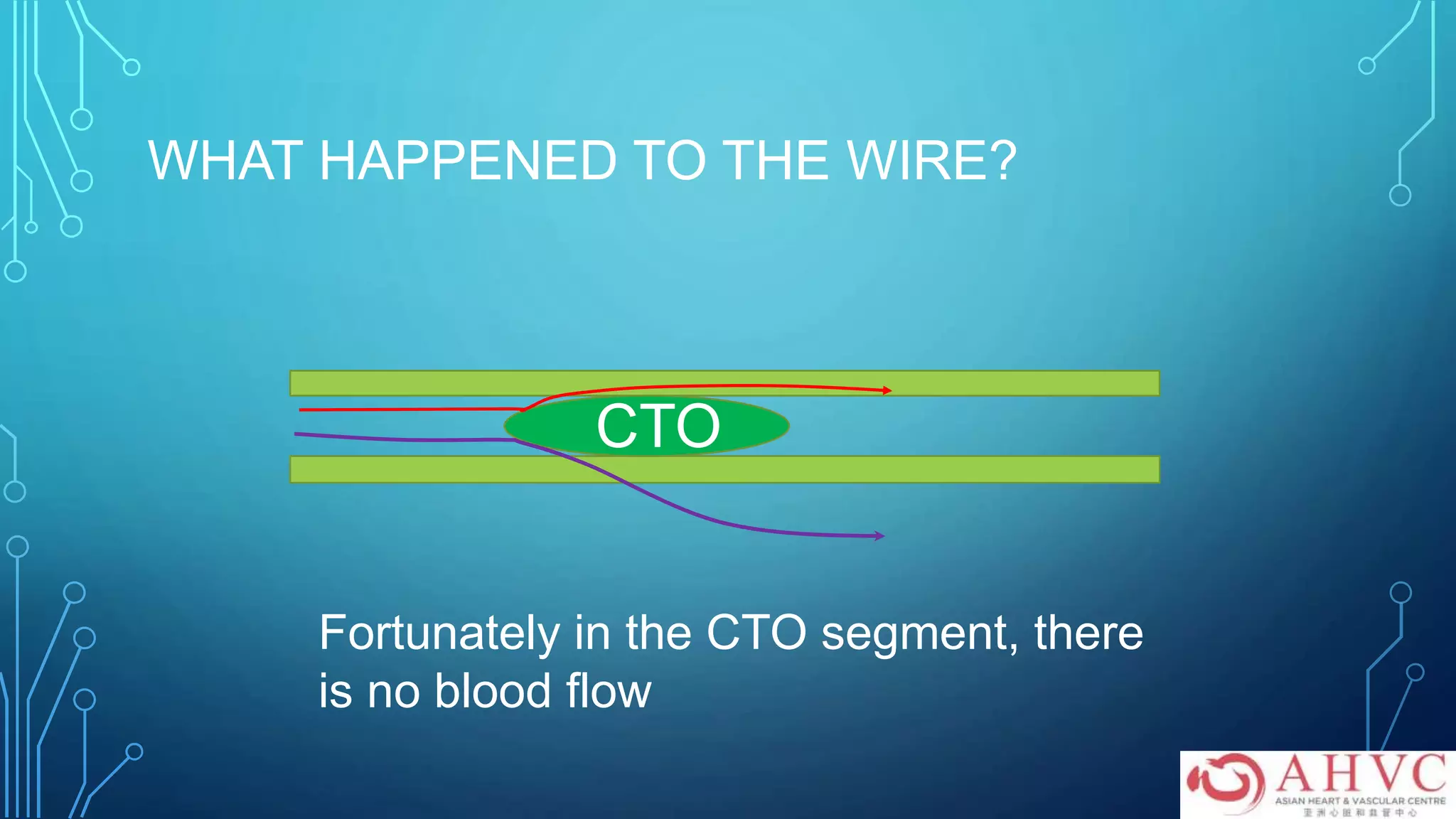 WHAT HAPPENED TO THE WIRE?
CTO
Fortunately in the CTO segment, there
is no blood flow
 