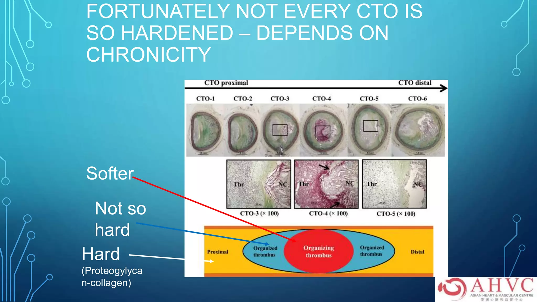 FORTUNATELY NOT EVERY CTO IS
SO HARDENED – DEPENDS ON
CHRONICITY
Hard
(Proteogylyca
n-collagen)
Not so
hard
Softer
 
