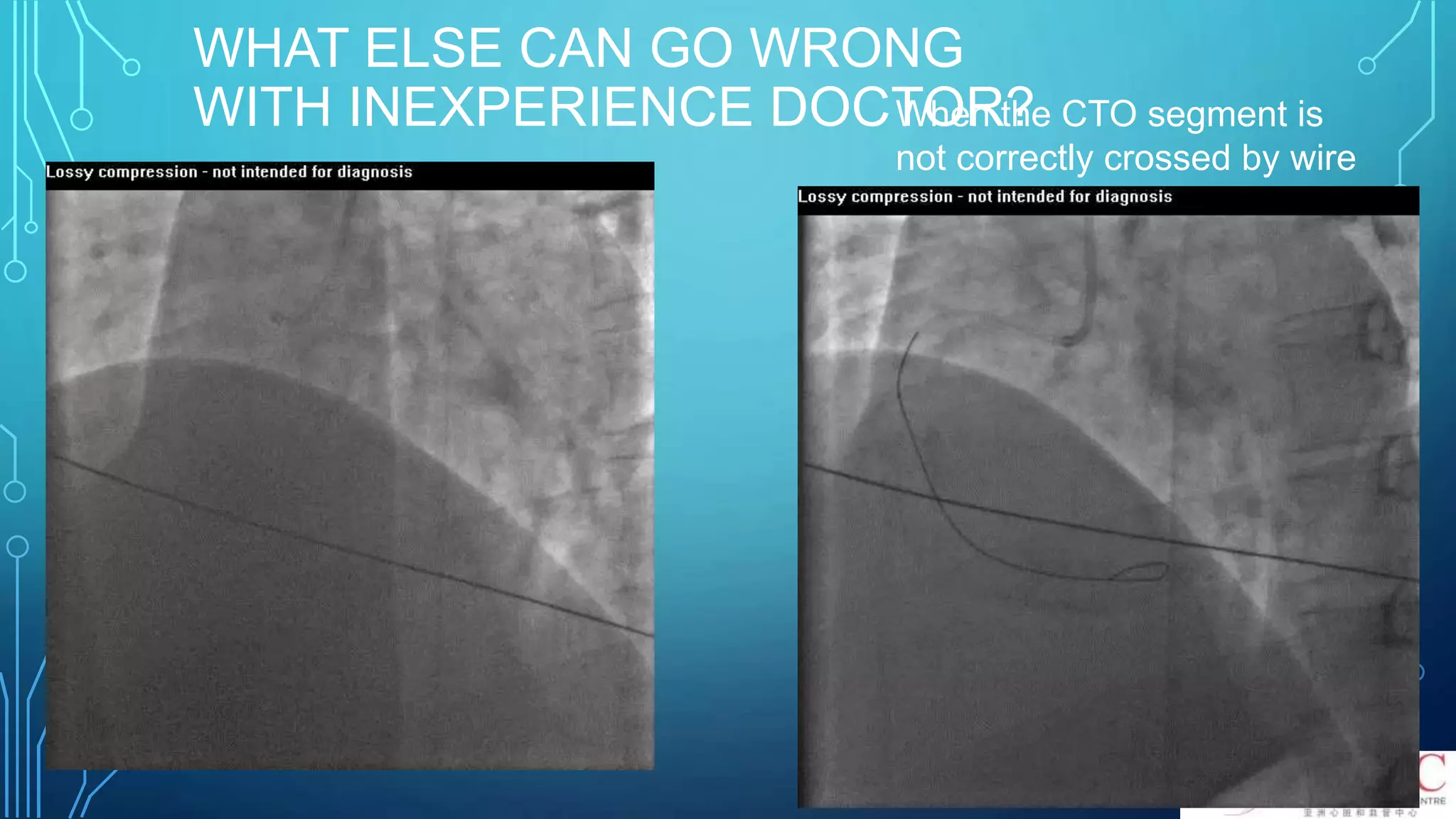 WHAT ELSE CAN GO WRONG
WITH INEXPERIENCE DOCTOR?When the CTO segment is
not correctly crossed by wire
 