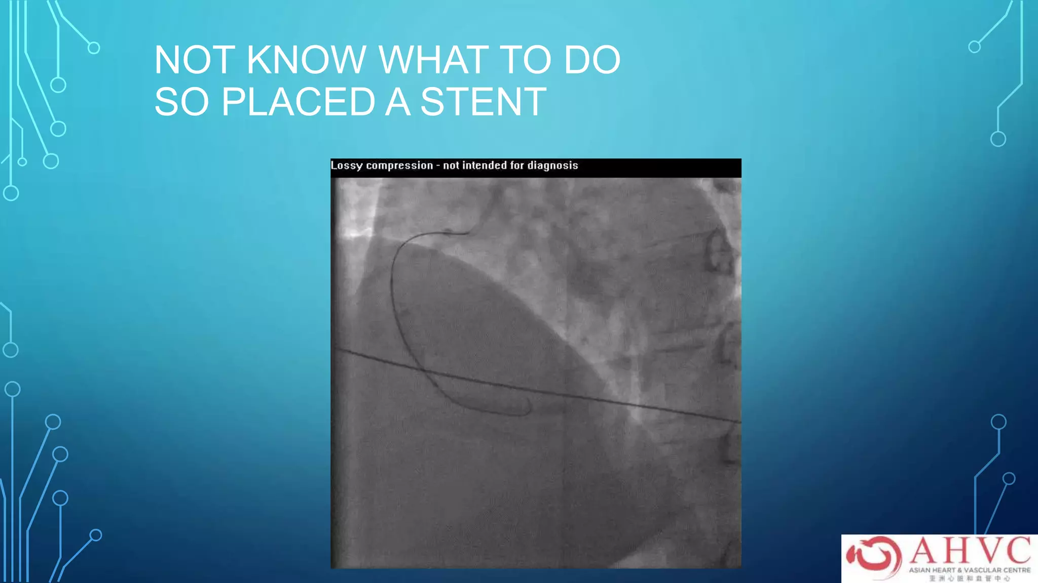 NOT KNOW WHAT TO DO
SO PLACED A STENT
 