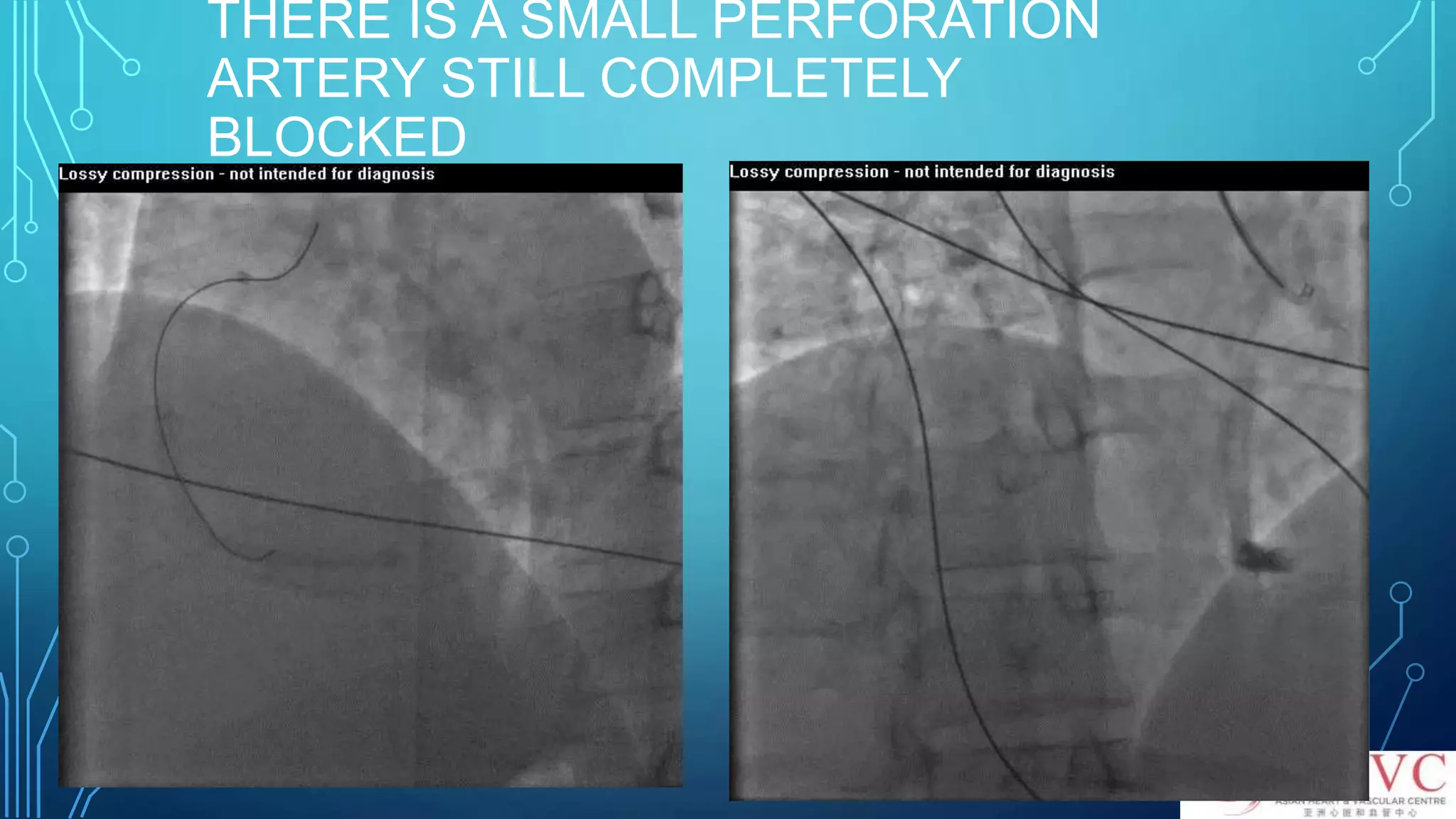 THERE IS A SMALL PERFORATION
ARTERY STILL COMPLETELY
BLOCKED
 