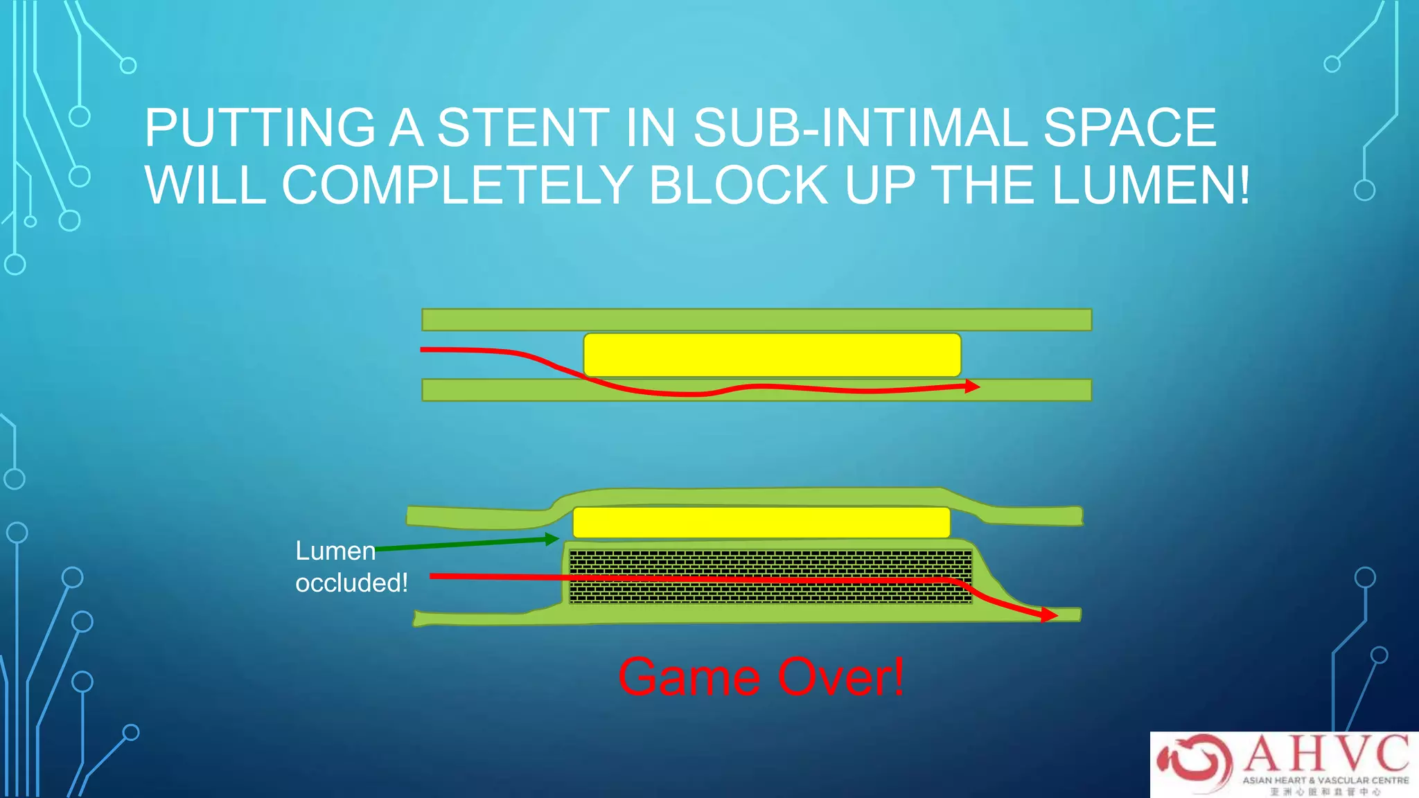 PUTTING A STENT IN SUB-INTIMAL SPACE
WILL COMPLETELY BLOCK UP THE LUMEN!
Lumen
occluded!
Game Over!
 