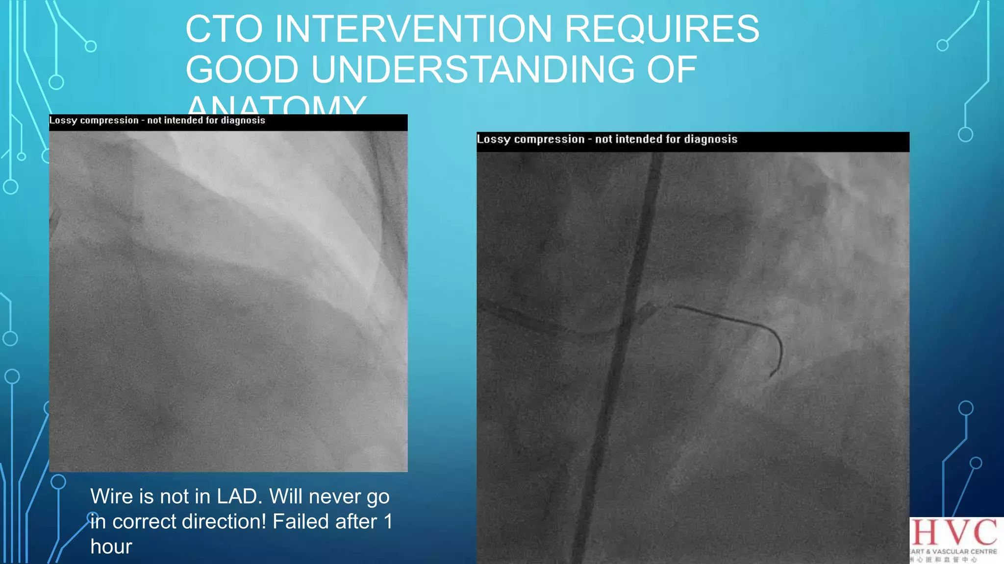 CTO INTERVENTION REQUIRES
GOOD UNDERSTANDING OF
ANATOMY
Wire is not in LAD. Will never go
in correct direction! Failed after 1
hour
 