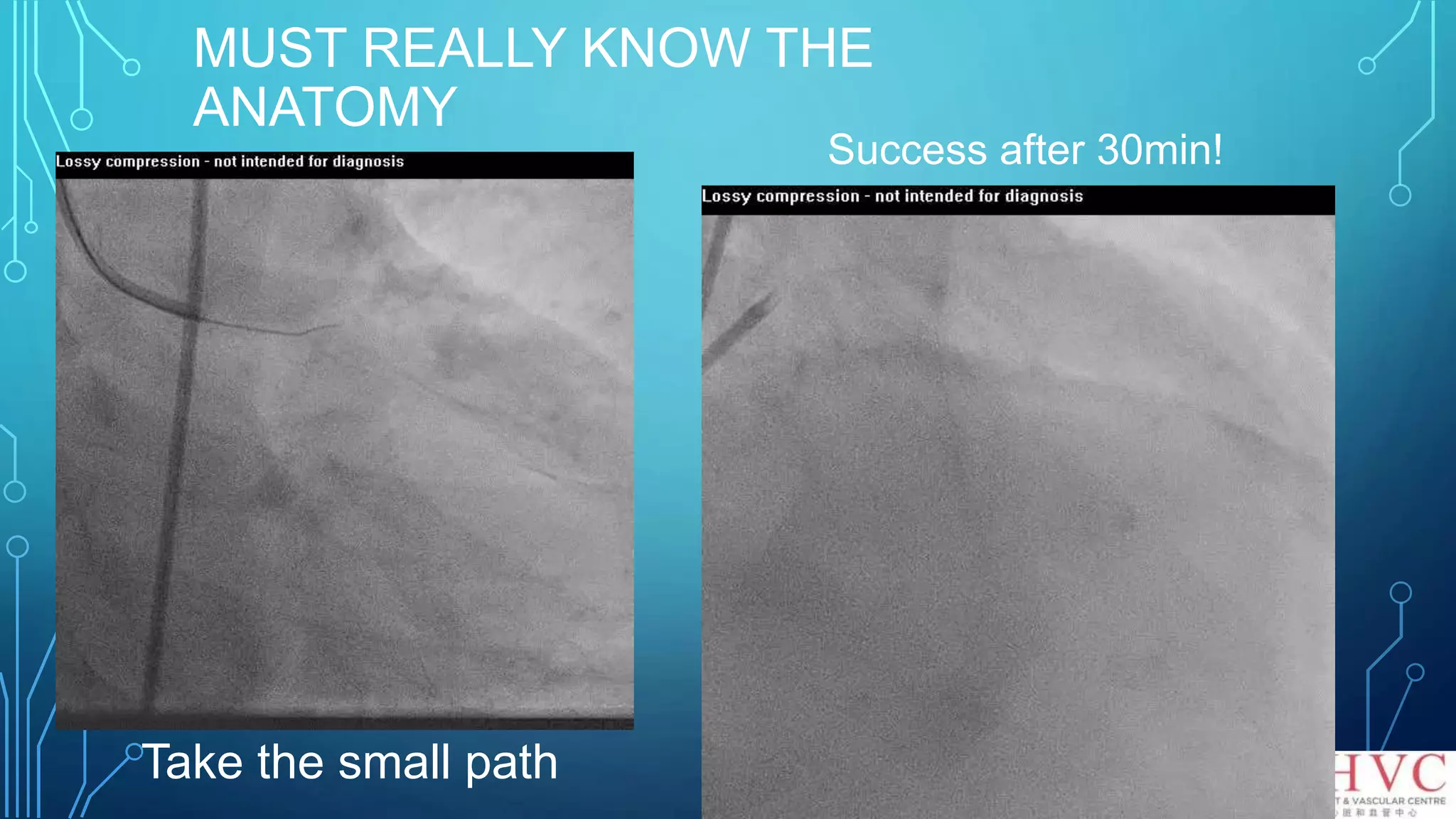 MUST REALLY KNOW THE
ANATOMY
Take the small path
Success after 30min!
 