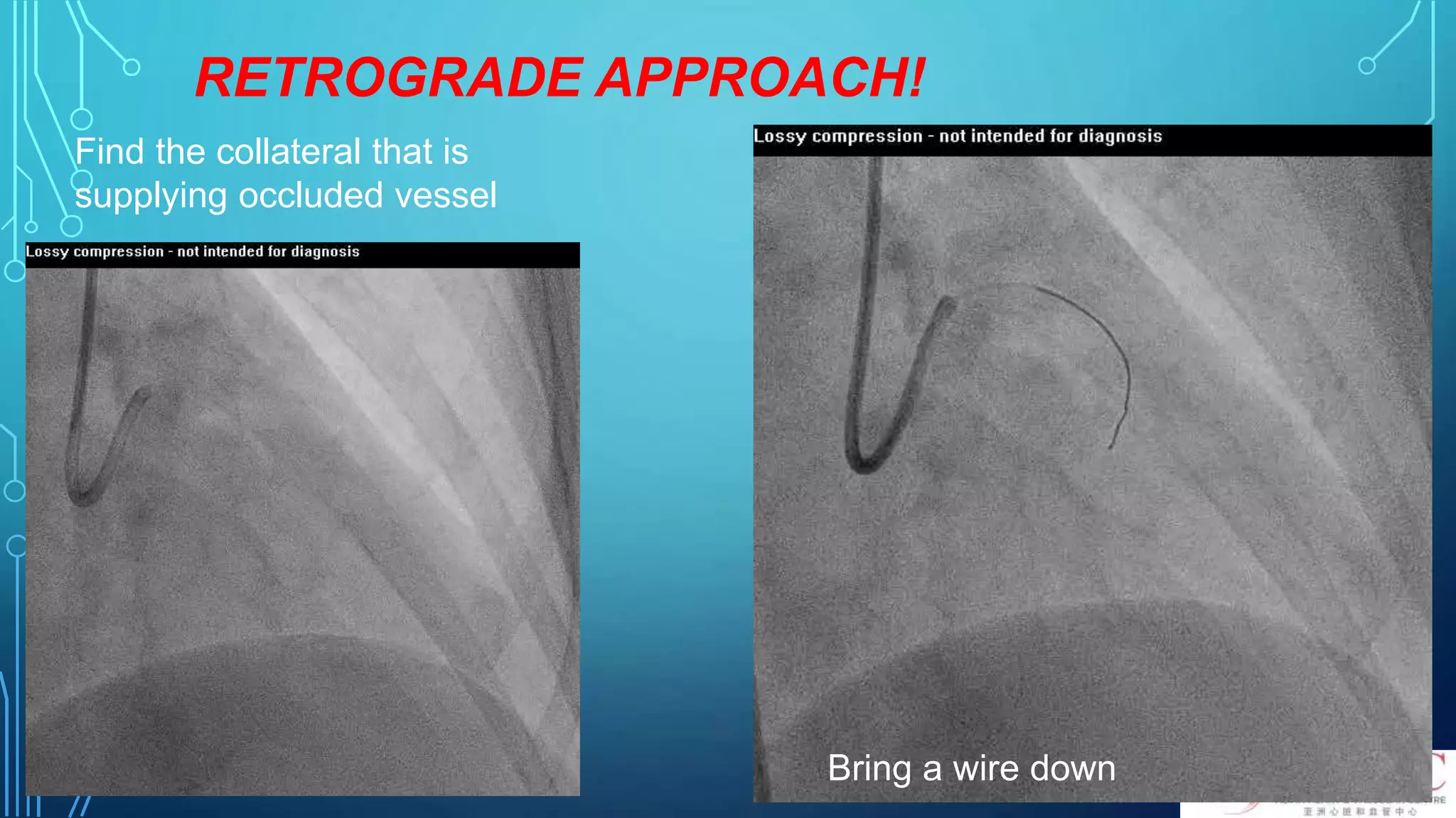 RETROGRADE APPROACH!
Find the collateral that is
supplying occluded vessel
Bring a wire down
 