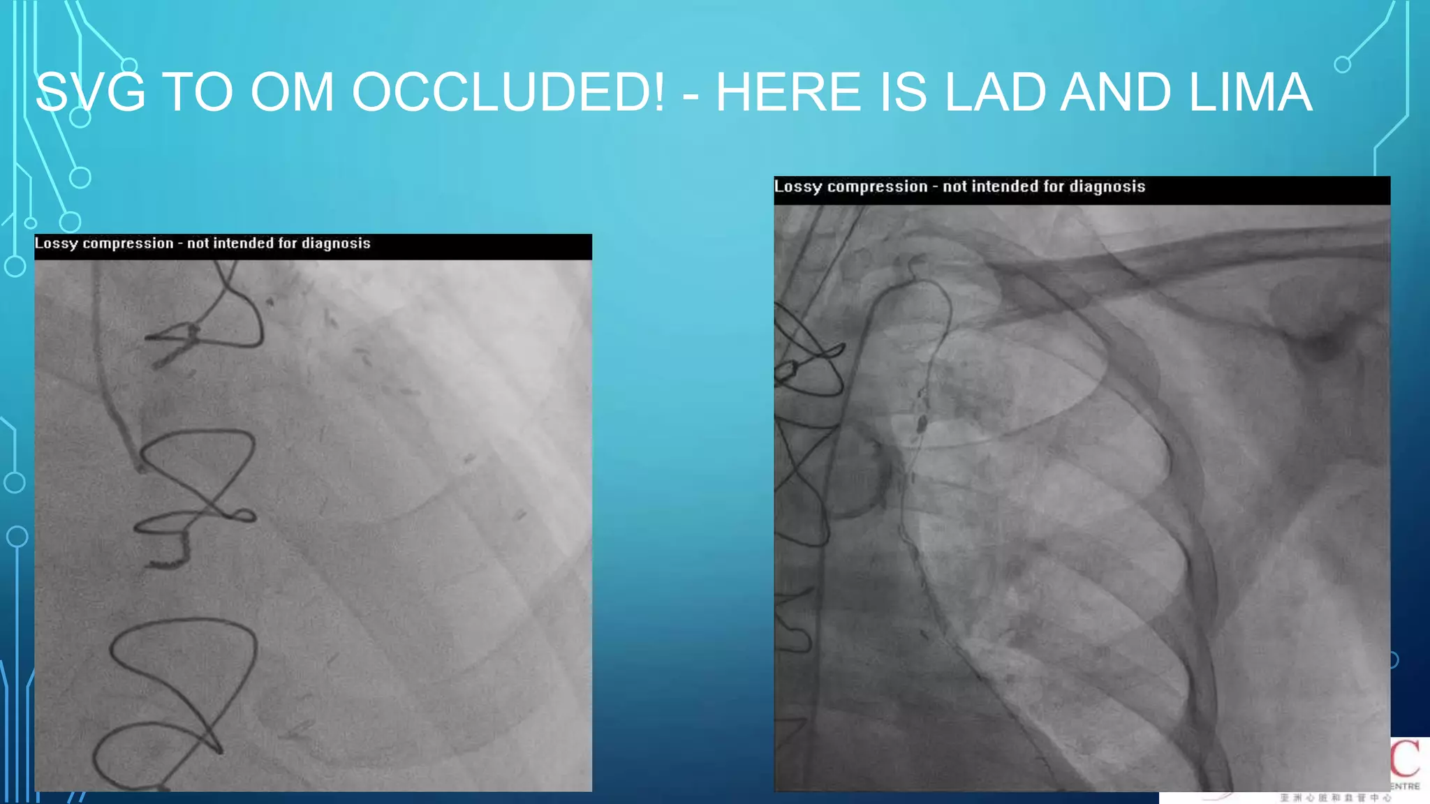 SVG TO OM OCCLUDED! - HERE IS LAD AND LIMA
 