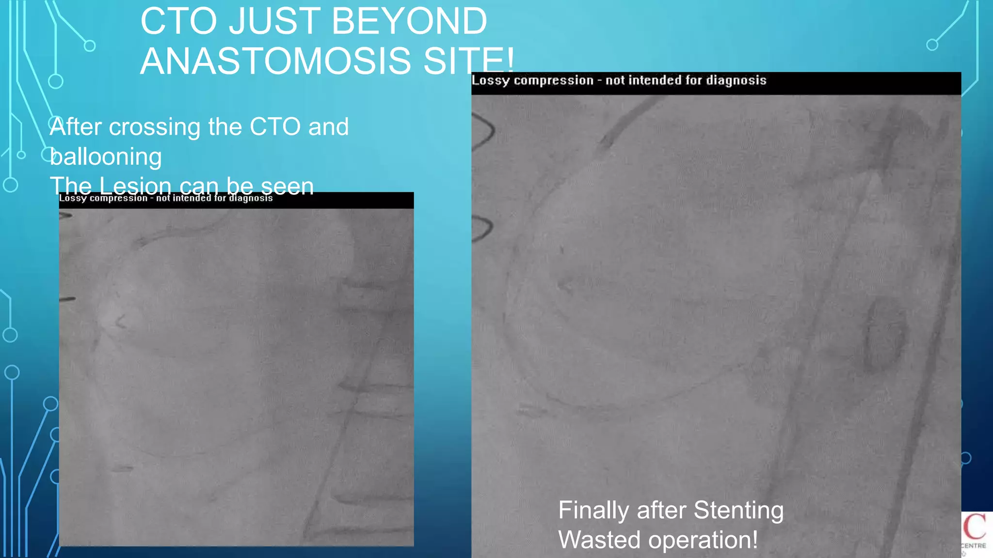 CTO JUST BEYOND
ANASTOMOSIS SITE!
After crossing the CTO and
ballooning
The Lesion can be seen
Finally after Stenting
Wasted operation!
 