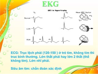 EKG
ECG: Trục lệch phải (120-150 ) ở trẻ tím, không tím thì
truc bình thường. Lớn thất phải hay lớn 2 thất (thể
không tím). Lớn nhĩ phải.
Siêu âm tim: chẩn đoán xác định
 