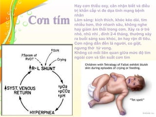 Cơn tím
Hay cơn thiếu oxy, cần nhận biết và điều
trị khẩn cấp vì đe dọa tính mạng bệnh
nhân
Lâm sàng: kích thích, khóc kéo dài, tím
nhiều hơn, thở nhanh sâu, không nghe
hay giảm âm thổi trong cơn. Xảy ra ở trẻ
nhỏ, nhũ nhi , đỉnh 2-4 tháng, thường xảy
ra buổi sáng sau khóc, ăn hay rặn đi tiêu.
Cơn nặng dẫn đến lả người, co giật,
ngưng thở tử vong.
Không có mối liên quan giữa mức độ tím
ngoài cơn và tần suất cơn tím
 