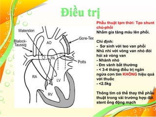 Điều trị
Phẫu thuật tạm thời: Tạo shunt
chủ-phổi
Nhằm gia tăng máu lên phổi.
Chỉ định:
- Sơ sinh với teo van phổi
Nhũ nhi với vòng van nhỏ đòi
hỏi xẻ vòng van
- Nhánh nhỏ
- Đm vành bất thường
- < 3-4 tháng điều trị ngăn
ngừa cơn tím KHÔNG hiệu quả
với thuốc
- <2.5kg
Thông tim có thể thay thế phẫu
thuật trong vài trường hợp đặt
stent ống động mạch
 