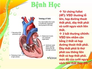 Bệnh Học
 Tứ chứng Fallot
(4F): VSD thường lỗ
lớn, hẹp đường thoát
thất phải, dày thất phải
và cưỡi ngựa vách liên
thất.
 2 bất thường chính:
VSD lớn nhằm cân
bằng 2 thất và hẹp
đường thoát thất phải.
Dày thất phải là thứ
phát sau thông liên
thất và hẹp thất phải.
mức độ của cưỡi ngựa
vách liên thất thay đổi
 