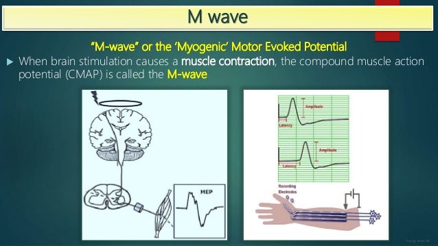 Transcranial Motor Evoked Potentials Monitoring Per Aacns Guidelines