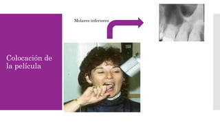 Colocación de 
la película 
Molares inferiores 
 