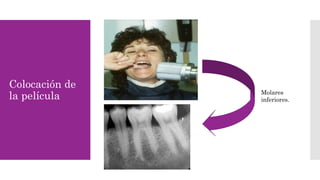 Colocación de 
la película Molares 
inferiores. 
 