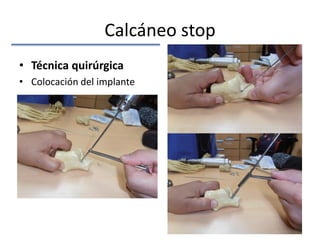 Calcáneo stop
• Técnica quirúrgica
• Colocación del implante
 
