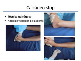 Calcáneo stop
• Técnica quirúrgica
• Abordaje y posición del paciente
 