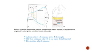  Aplicar entre 4 a 6 semanas antes de la cirugía.
 100 U de toxina en total (10 U por punto de infiltración).
 Pico máximo a las 4 semanas
 
