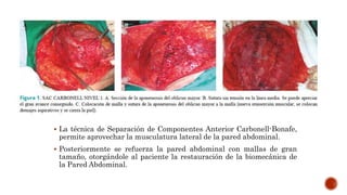  La técnica de Separación de Componentes Anterior Carbonell-Bonafe,
permite aprovechar la musculatura lateral de la pared abdominal.
 Posteriormente se refuerza la pared abdominal con mallas de gran
tamaño, otorgándole al paciente la restauración de la biomecánica de
la Pared Abdominal.
 