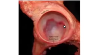 TÉCNICA OPERATORIA EN ARTROPLASTIA DE CADERA.pptx