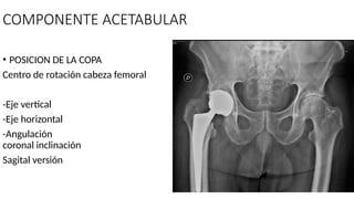 TÉCNICA OPERATORIA EN ARTROPLASTIA DE CADERA.pptx