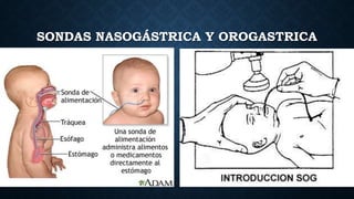SONDAS NASOGÁSTRICA Y OROGASTRICA
 