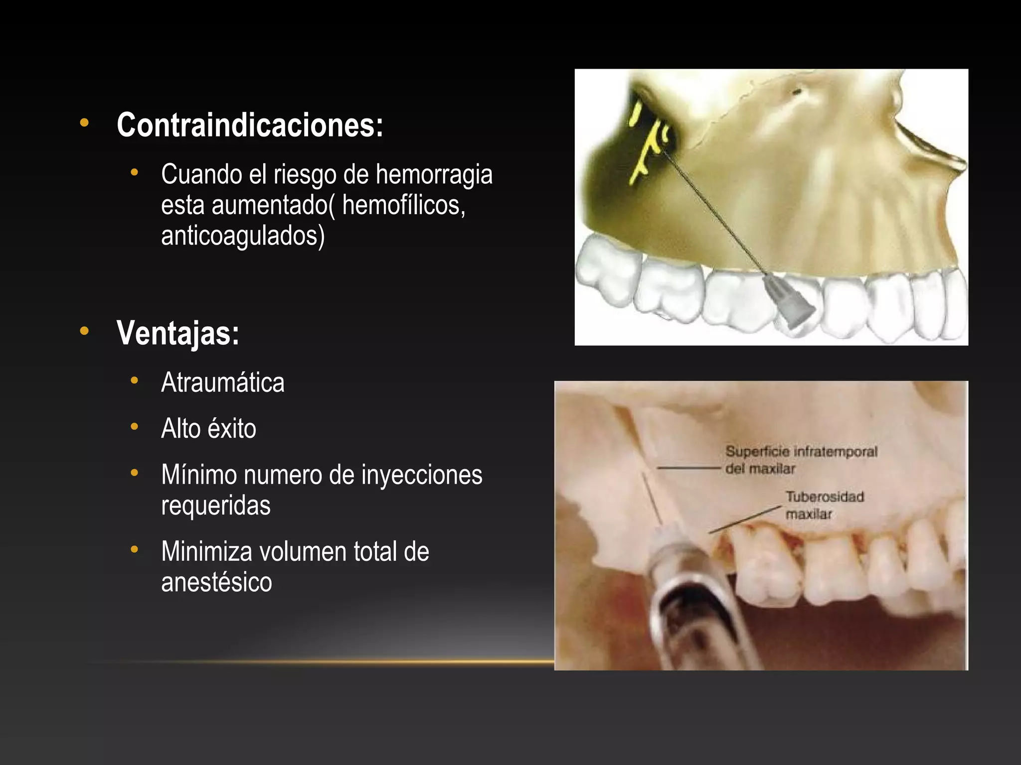 Técnicas de anestesia en maxilar superior